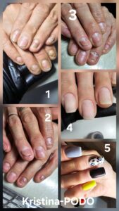 Deformation of the nail plate, onycholysis, onychorrhexis