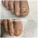 Fungal infection, Calluses, warts, cracks, corns