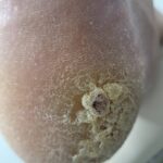 Ingrown toenail treatment