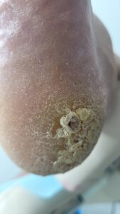 Ingrown toenail treatment