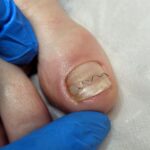 Callus treatment